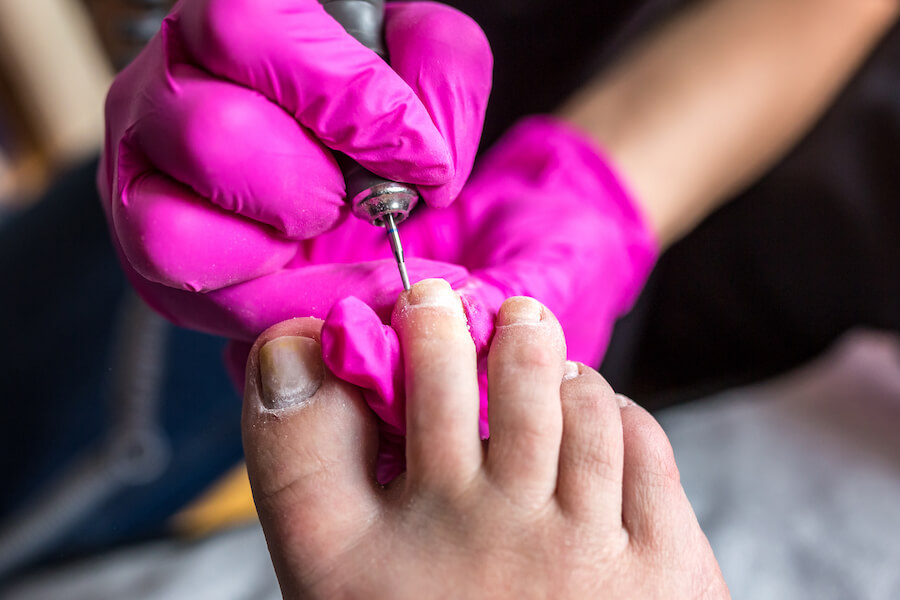 Dłubanie w paznokciach stóp